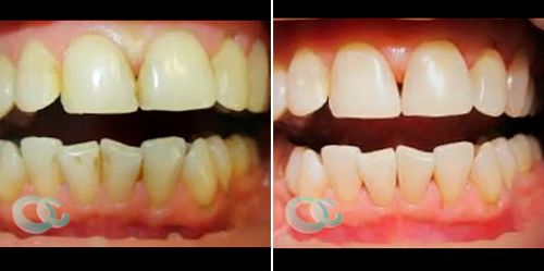 Dentální hygienou proti padání zubů